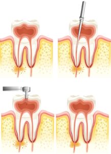 Root Canal Treatment