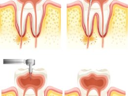 Root Canal Treatment