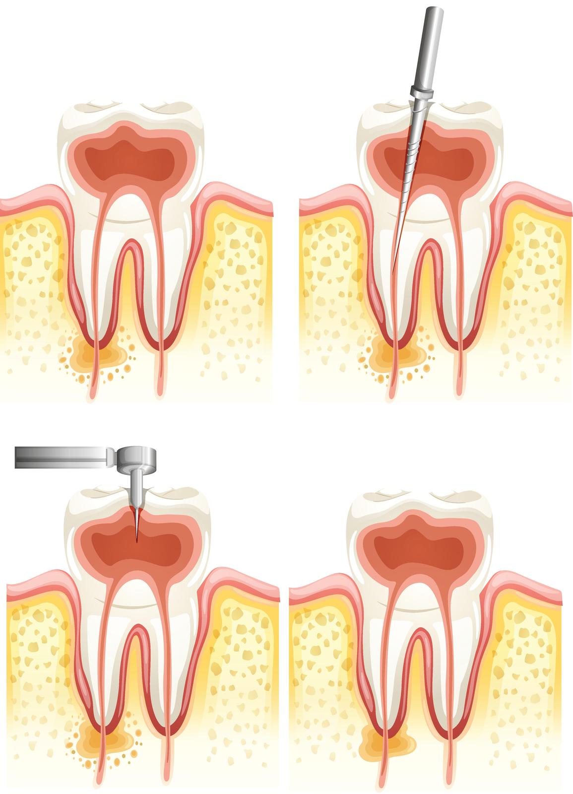 Root Canal Treatment